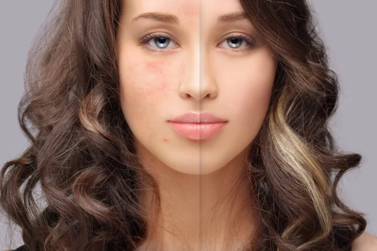 Acne & Deep Scar Resurfacing