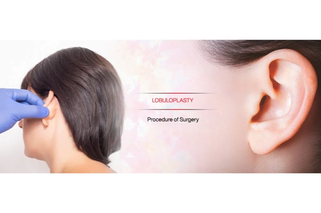 Lobuloplasty (Earlobe Repair)
