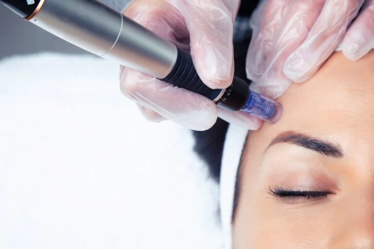 Clinical Microneedling (Dermapen)