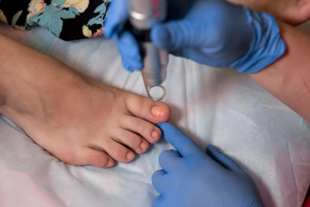 Ingrown Nail Surgery