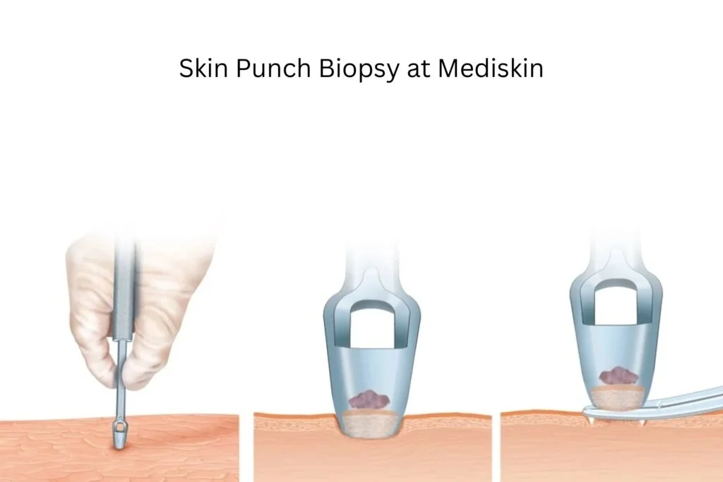Clinical Skin Punch Biopsy