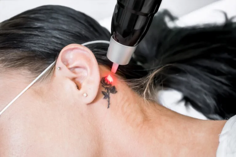 Advanced Laser Tattoo Removal