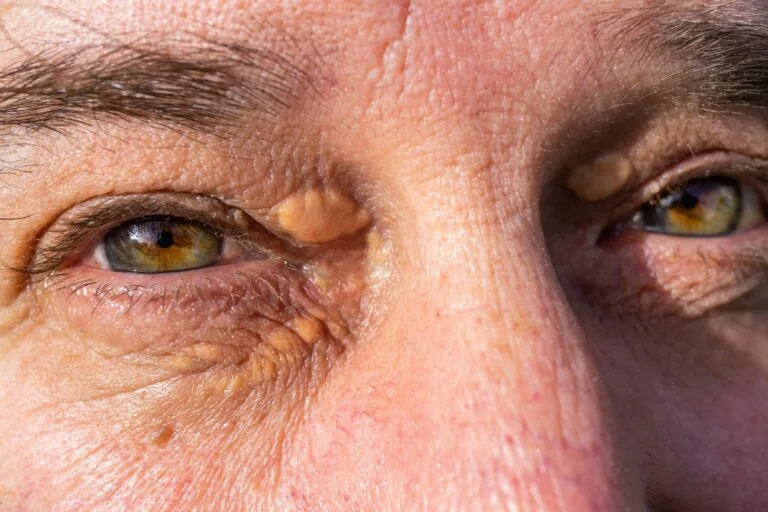 Xanthelasma Deposition Removal